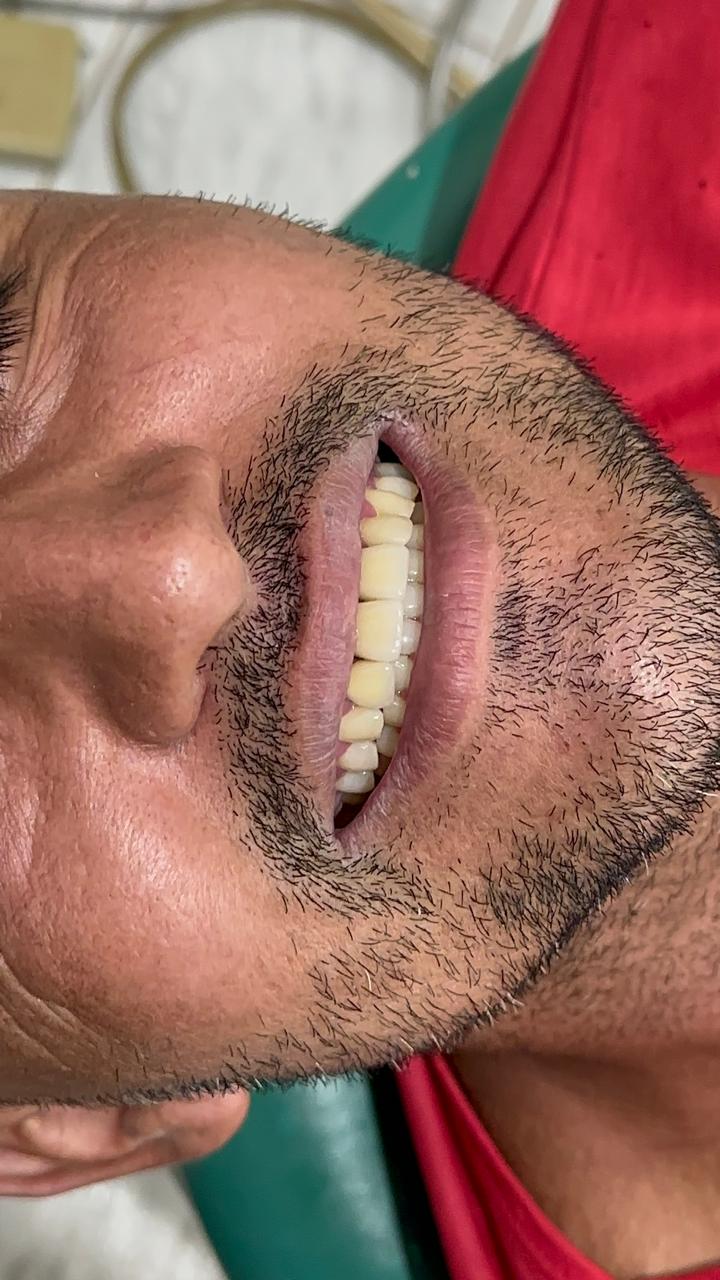 Depois do tratamento — Marcos L.